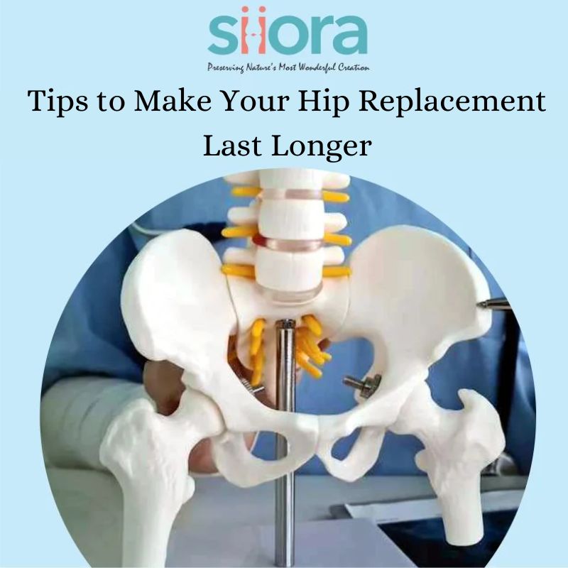 Tips to Make Your Hip Replacement Last&nbsp;Longer